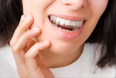 ᐉ Элайнеры для выравнивания зубов | Ортодонтическая стоматология в Одессе  клиника \"Астерия\"