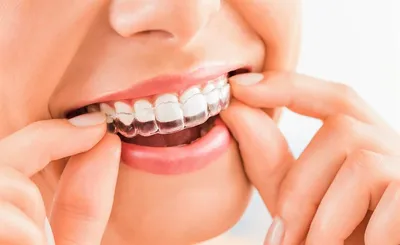 Элайнеры - «Исправление зубов дома без единого похода к врачу или  Инвизалайн для бедных - Straight Teeth Direct. Фото зубов в элайнерах,  скрины, слепки. Обновление фото зубов до и после 11 мес.» | отзывы
