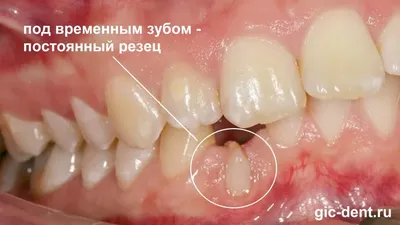 Элайнеры для зубов Омске, цены и сроки