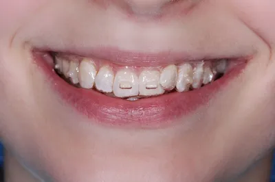 Пациентка 33 года - элайнеры Star Smile, диастема, сужение зубных рядов,  смещение центральной линии