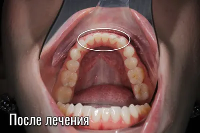 Элайнеры вытягивают зубы лучше брекетов - Немецкий имплантологический центр
