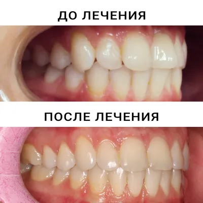 Элайнеры для выравнивания зубов: диагностика, причины, установка кап и  флексов для лечения неправильного прикуса в Санкт-Петербурге