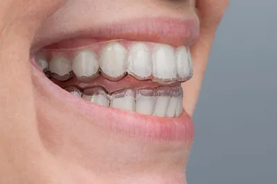 Элайнеры Star Smile в Волжском в стоматологии ДАША