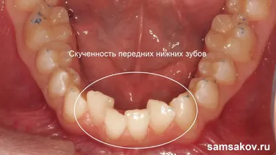 https://samson-denta.ru/services/ortodontiya/elaynery/