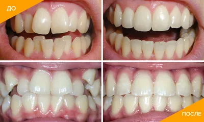 Кейс №1: элайнеры для выравнивания зубов - примеры работ стоматологии KANO