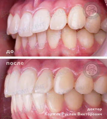 Элайнеры для выравнивания зубов в Иркутске