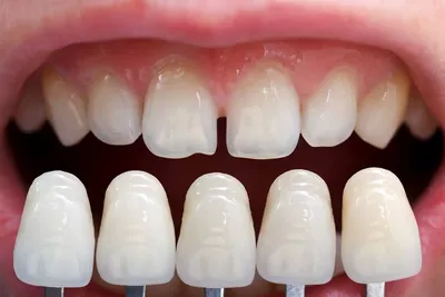 Лечение скученности зубов у девушки в 15 лет - почему элайнеры, а не  брекеты. Альянс бьюти-стоматологов, Москва