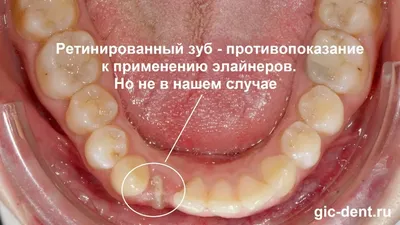 Orthosnap — отзывы, цены, особенности лечения на элайнерах Ортоснеп на  Startsmile.ru