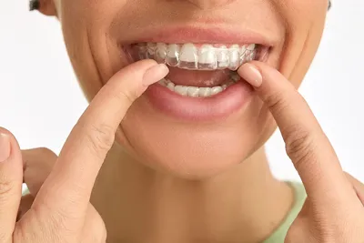 Элайнеры для зубов – новый тренд в современной стоматологии!