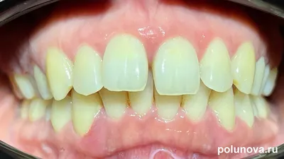 Элайнеры На 32 Зуба Это Что Такое Ортодонтические ЛюмиДент