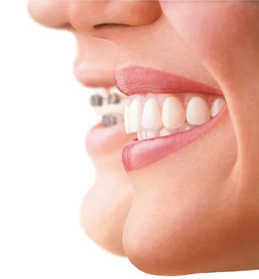Скученность зубов – лечение элайнерами