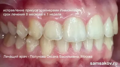 Элайнеры для выравнивания зубов в Ростове-на-Дону, цены в клинике Шувалова