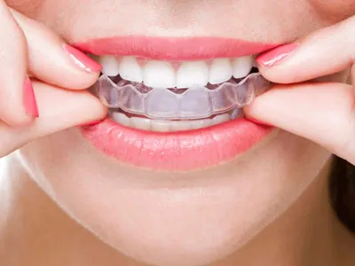 Элайнеры для выравнивания зубов – цена от 7500 ₽ - клиника Медикор