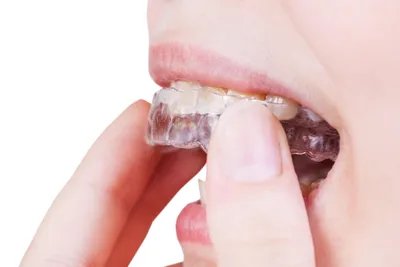 Выравнивание зубов элайнерами - Стоматология \"Скаковский\"