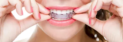 Элайнеры для выравнивания зубов в Москве - цена на элайнеры в стоматологии  \"Стом-Студио\"