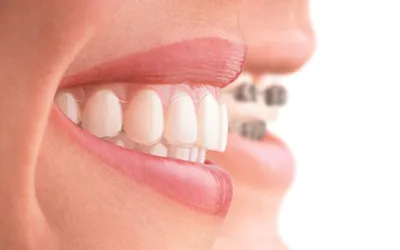 Элайнеры вытягивают зубы лучше брекетов - Немецкий имплантологический центр