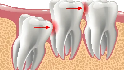 Удаление зуба: как долго заживает лунка | Dental Art