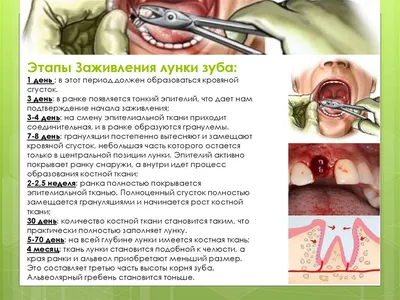 Этапы заживления лунки после удаления зуба - презентация онлайн
