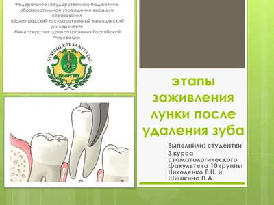 Этапы заживления лунки после удаления зуба - презентация онлайн
