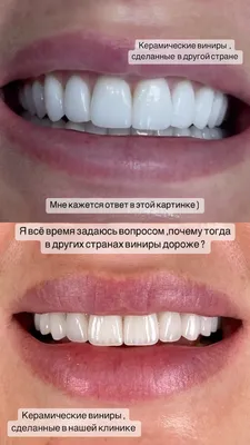 Керамические виниры на зубы - цена в Москве