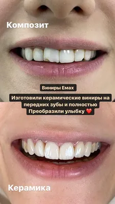 Керамические виниры в Минске, цена на установку виниров за 1 зуб