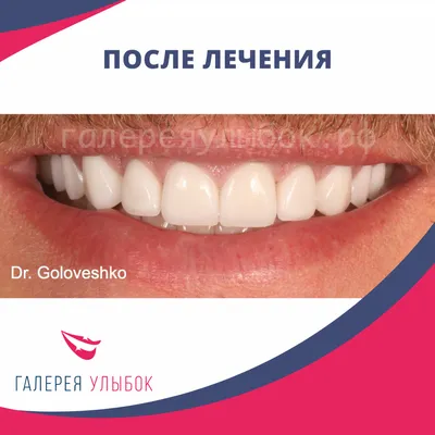 Цена на установку керамических виниров на зубы - спецпредложение со скидкой  до 50% в Москве