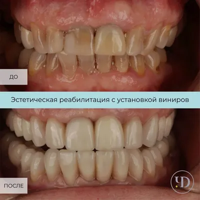 Виниры в Киеве. Реставрация зубов с помощью виниров в Киеве | Dentera