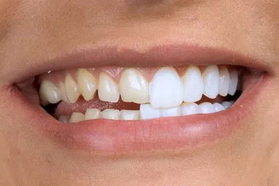 Керамические виниры на рефракторе - Ортодонтия и Детская стоматология