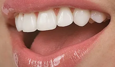 Dentalika - ➡️ Что такое керамические виниры? Тончайшие пластины из прочной  безметалловой керамики, которые сохраняют ваши родные зубы, но кардинально  преображают их внешний вид. При этом вмешательство в собственные ткани зуба  минимально,