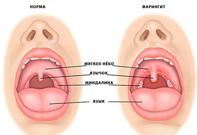 Фарингит: признаки, симптомы, лечение - МедКом