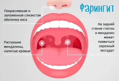 Фарингит: причины возникновения, описание симптомов, диагностика и лечение  - MEDСЕМЬЯ