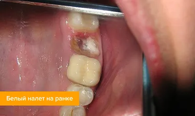 Фибринозный налет после удаления зуба фото фотографии