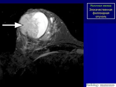 Фиброаденома фото маммографии фотографии