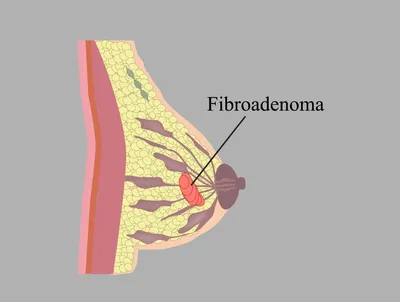 Диагноз: фиброаденома молочной железы | anastasea1991 | Дзен