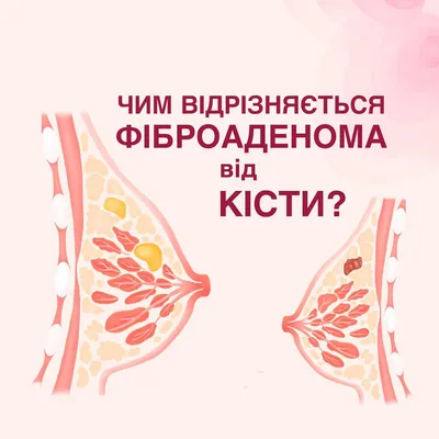 Чем отличается фиброаденома от кисты? | Маммологический Центр