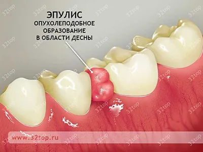 Лечение эпулиса на десне в Москве - Цены на Лечение эпулиса на десне в  стоматологии