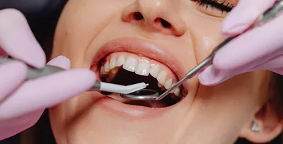 Нарыв на десне возле зуба