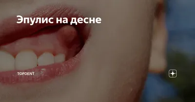 Доброкачественные новообразования зуба и их лечение- Немецкий  имплантологический центр, Москва