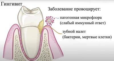 Эпулис на десне | TopDent | Дзен