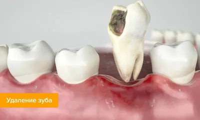 Доброкачественные новообразования зуба и их лечение- Немецкий  имплантологический центр, Москва