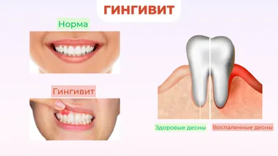 Белый налет на десне после удаления зуба