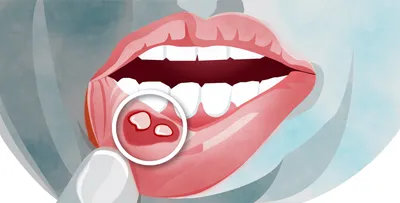 Фиброзный пульпит - лечение хронического фиброзного пульпита в стоматологии  в Москве