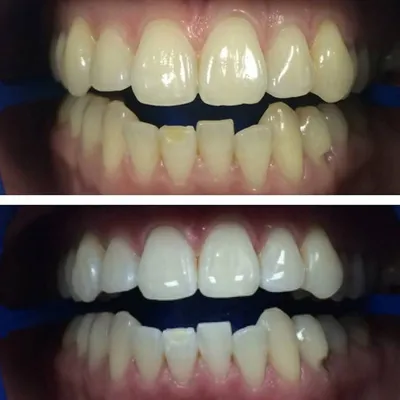 Белый нарост после удаления зуба в стоматологии