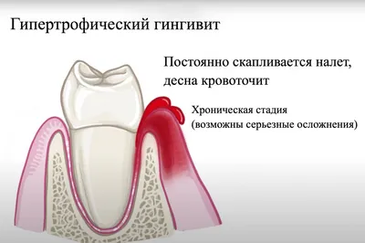 Лечение эпулиса на десне в Москве - Цены на Лечение эпулиса на десне в  стоматологии