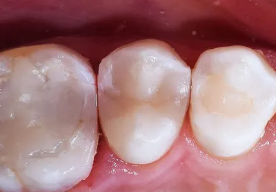 Гингивит - симптомы и лечение — стоматологическая клиника Эталон Ростов