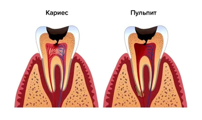 Лечение периодонтита зуба в Москве цены | Симптомы и причины острого  заболевания