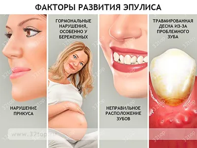 Гингивит: симптомы, виды, причины и как лечить - DentBerg