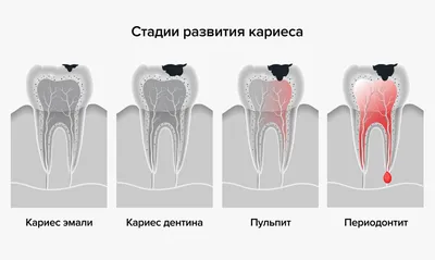 Лечение периодонтита зуба в Москве цены | Симптомы и причины острого  заболевания