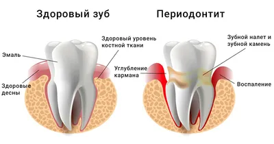 Флюороз зубов: причины, симптомы, лечение, фото, цены на эндемический  флюороз зубов, профилактика