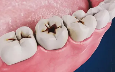 Удаление зуба с гранулемой, операция по удалению гранулемы зуба в Москве